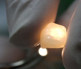  Vollkeramikkronen sind wie der natürliche Zahn lichtdurchlässig und ermöglichen daher die höchste Ästhetik. 