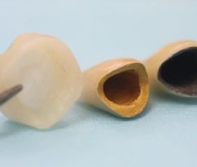  Hier sind die 3 Grundformen von Kronen zu sehen. Von links nach rechts: Vollkeramikkrone, Goldkeramikkrone, Edelstahlkeramikkrone. 