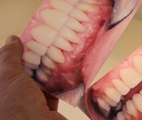  Ästhetik Strahlendes Lächeln - Fotos , vom Zahnarzt und vom Zahntechniker, dokumentieren den Behandlungsverlauf. 